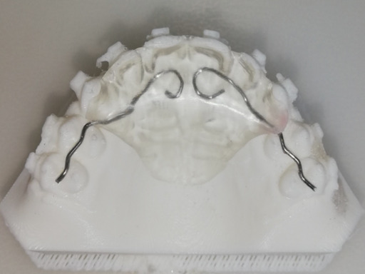 Le plan rétro-incisif